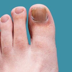 Everything You Should Know About Nail Fungus Infection and Its Treatment Method