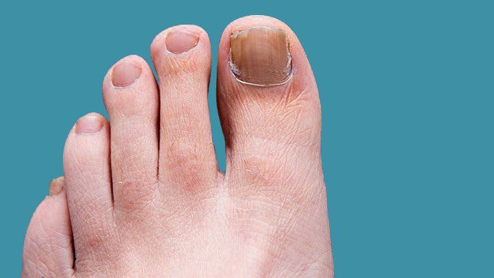 Everything You Should Know About Nail Fungus Infection and Its Treatment Method
