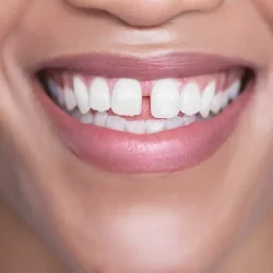 What You Should Know About Periodontal Reshaping