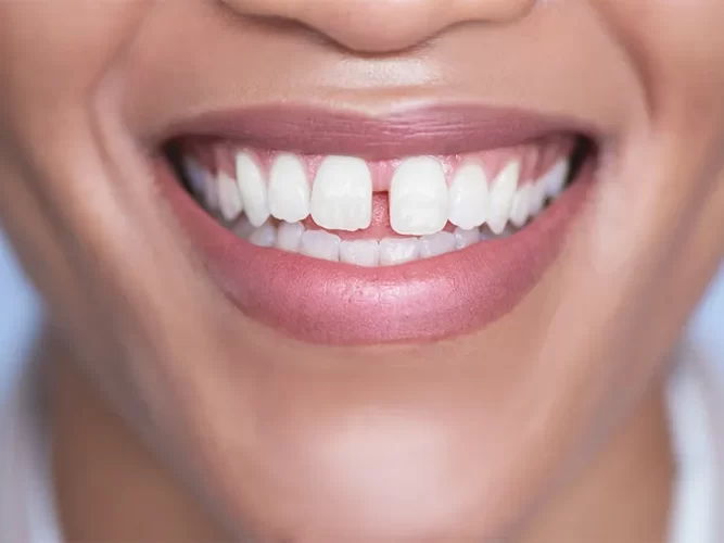 What You Should Know About Periodontal Reshaping