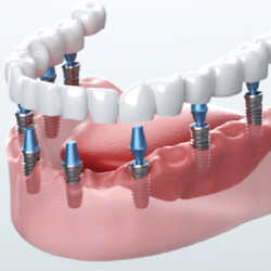 The Dental Implant Procedure: What to Expect During Your Surgery and Recovery