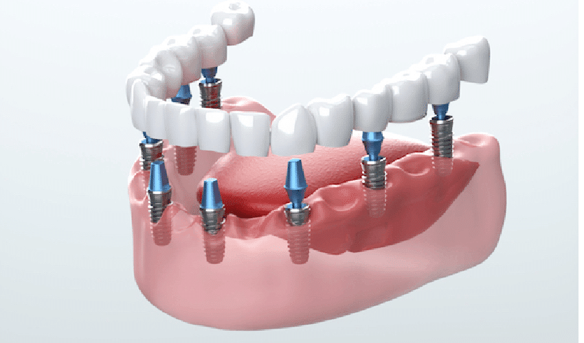 The Dental Implant Procedure: What to Expect During Your Surgery and Recovery