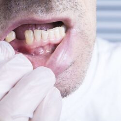 What Can You Expect After Tooth Removal?