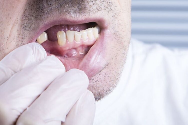 What Can You Expect After Tooth Removal?