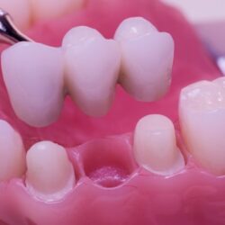 Why Are Dental Bridges Beneficial for Restoring Your Smile and Bite Function?