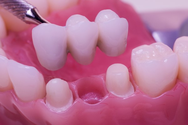 Why Are Dental Bridges Beneficial for Restoring Your Smile and Bite Function?