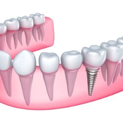 Which Advanced Dental Implant Procedures You Must Know About?