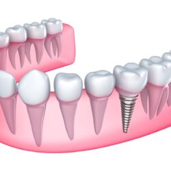 Which Advanced Dental Implant Procedures You Must Know About?