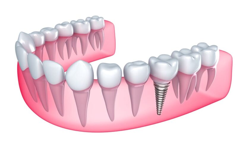 Which Advanced Dental Implant Procedures You Must Know About?