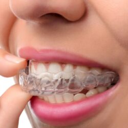 Preventing Crooked Teeth- Effective Tips From Dentists!