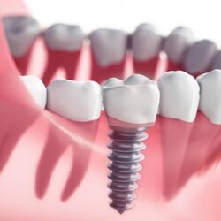 Why Dental Implants in Winnipeg are Popular Dental Restorative Solution
