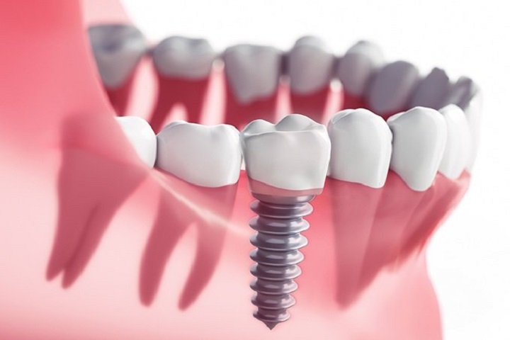 Why Dental Implants in Winnipeg are Popular Dental Restorative Solution