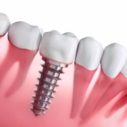 Should You Get Dental Implants If You Are Pregnant in Boston?