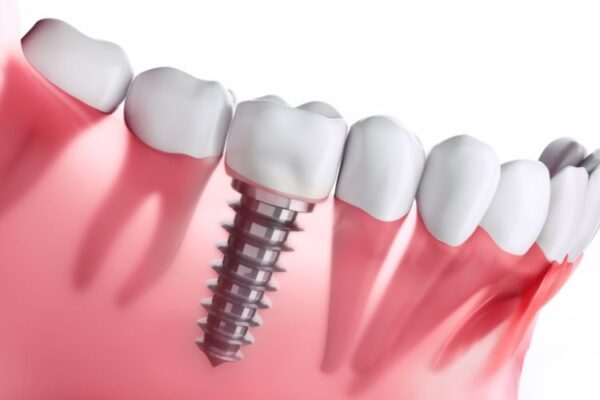 Should You Get Dental Implants If You Are Pregnant in Boston?