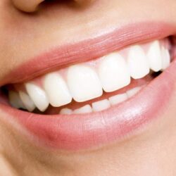Should I See a Dentist Before Getting My Teeth Whitened?