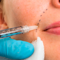 Does Wrinkle or Dermal Filler Work?