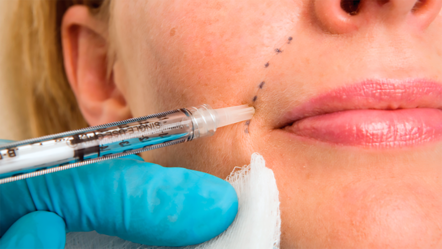 Does Wrinkle or Dermal Filler Work?