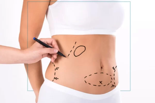 When is the best time to consider lipo 360?